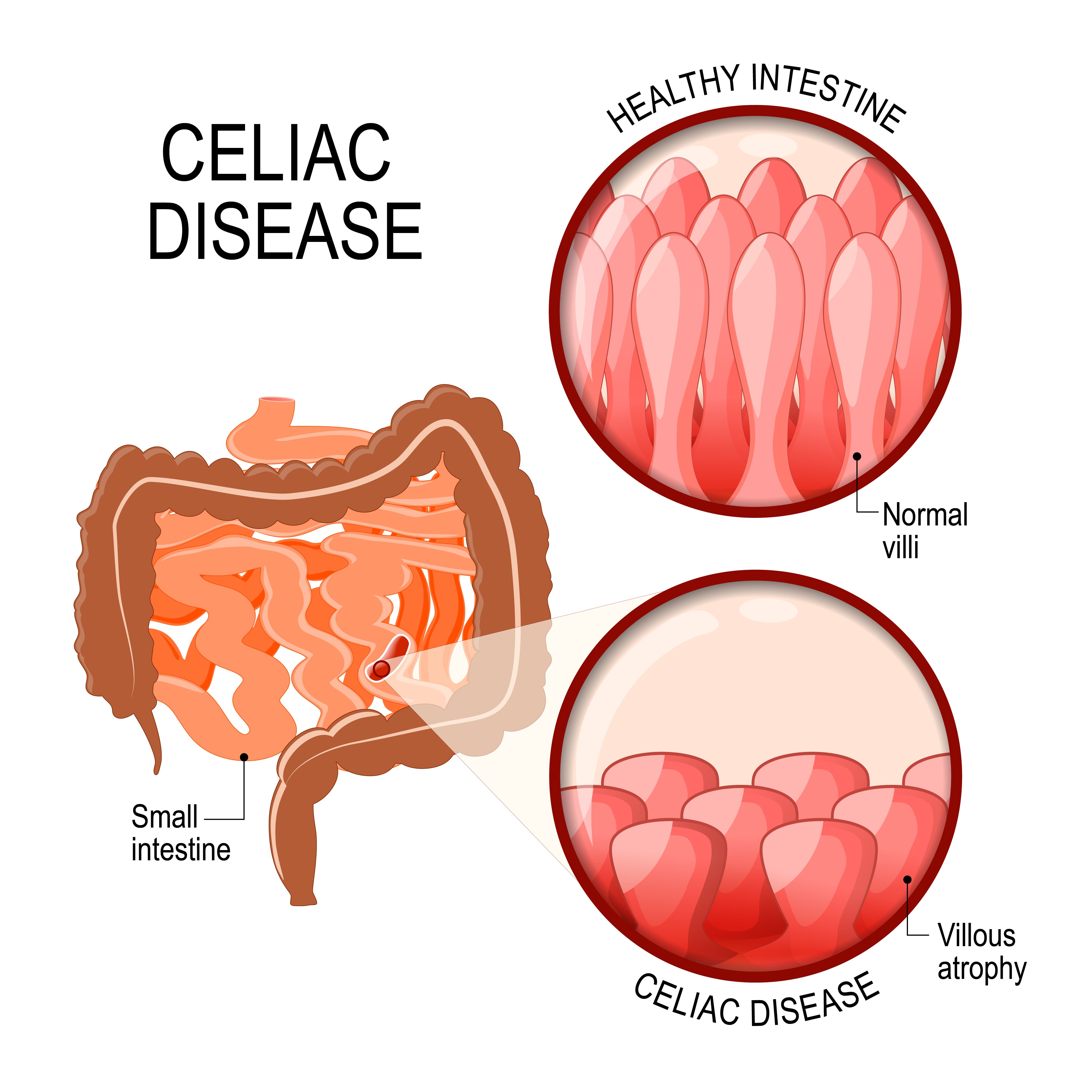 Celiac Disease diagram