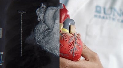x-ray of heart paired next to model of heart